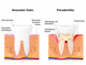 Parodontitisbehandlungen